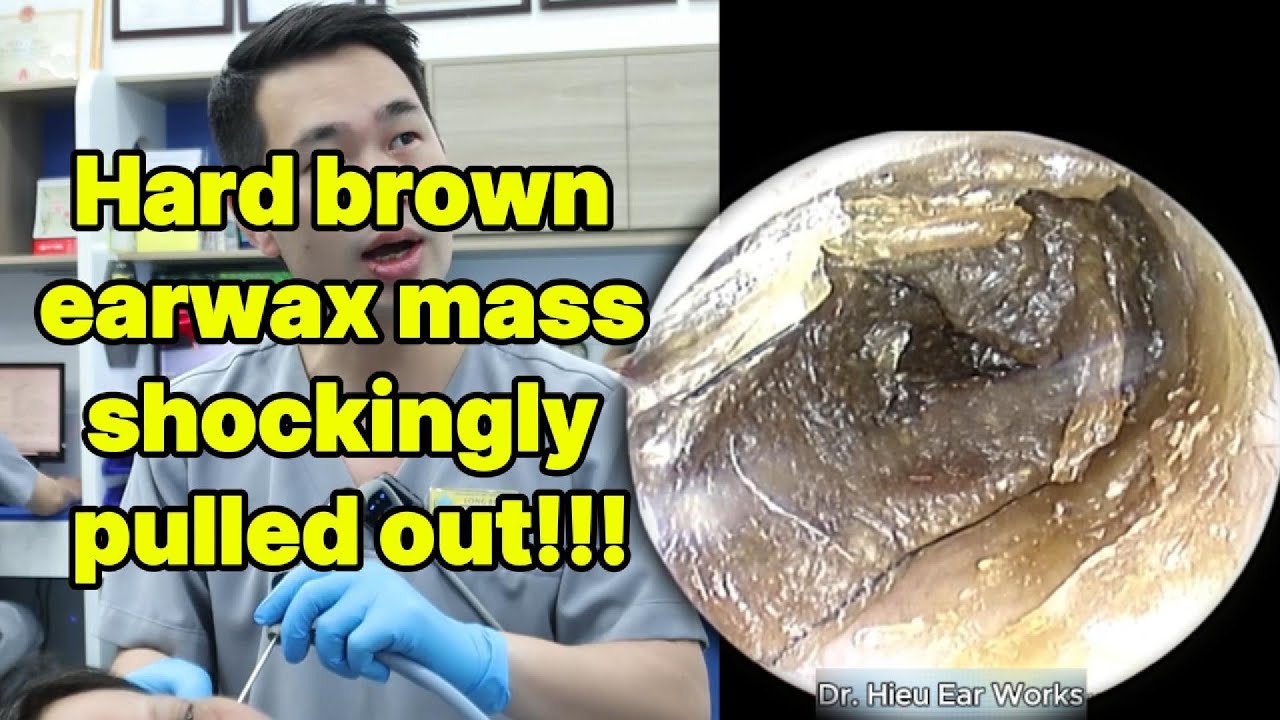 Hard brown earwax mass shockingly pulled out | ear cleaning | ASMR earwax | soothing |relax|