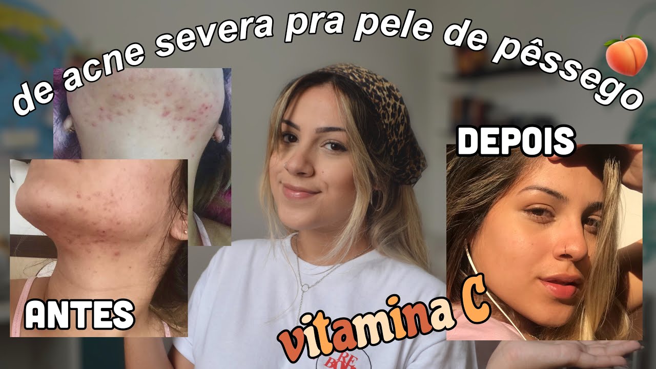 COMO CUREI MINHA ACNE SEVERA | Luany Almeida