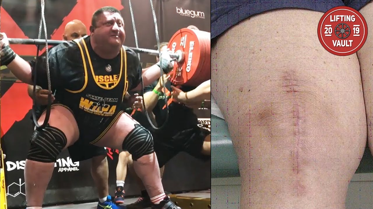 This Man Squatted 525 kg After A Full Knee Replacement