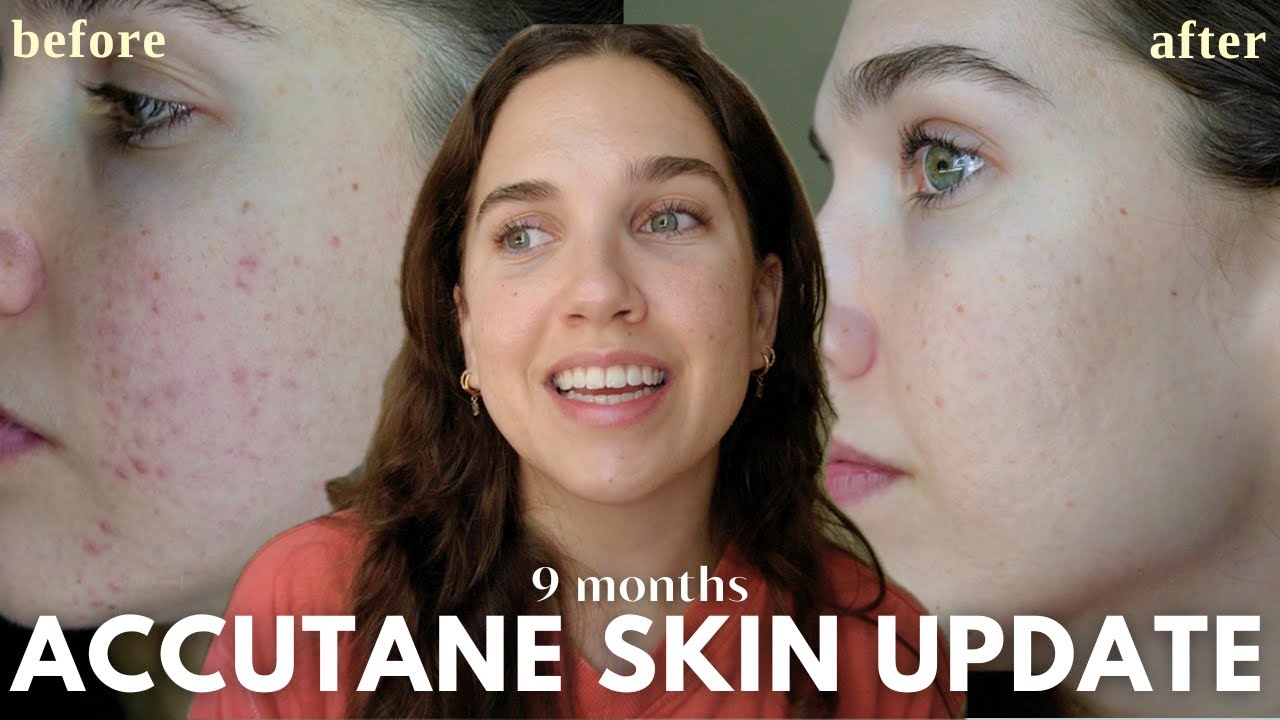 Roaccutane Daily Skin Diaries | Months 7-9 | Finally Clear! (Low Dose) | MILD ACNE