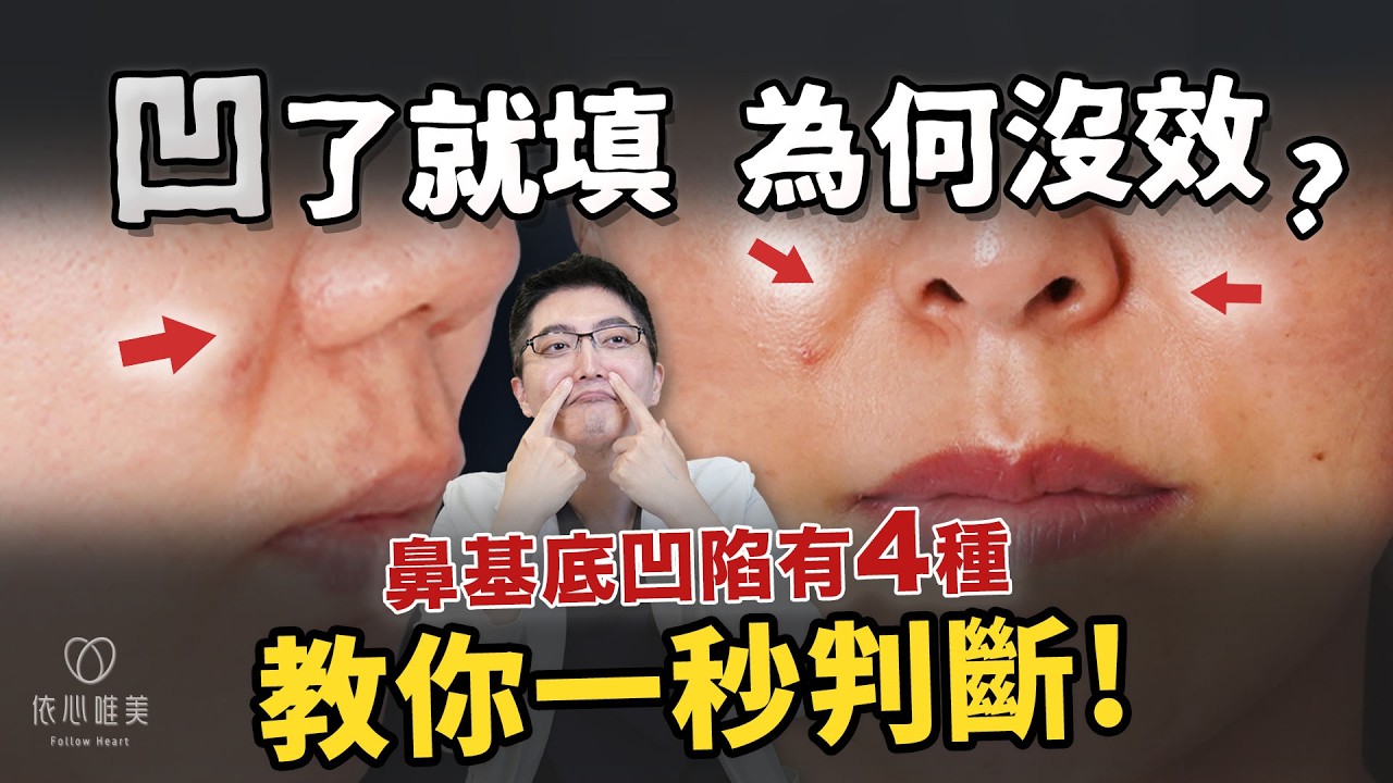 忽略這點，法令紋治療就無效！鼻基底凹？不是每個人都適合貴族手術！教你居家檢測自己是哪種法令紋？｜依心唯美 李京軒醫師