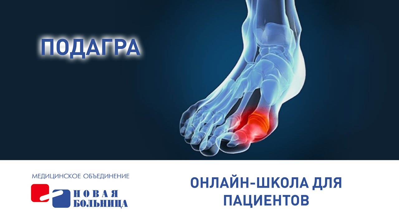 Подагра