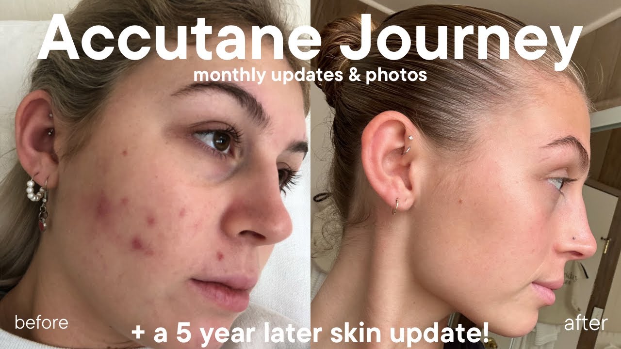 My Accutane Journey! (monthly updates, progress pictures, and a 5 year skin update)