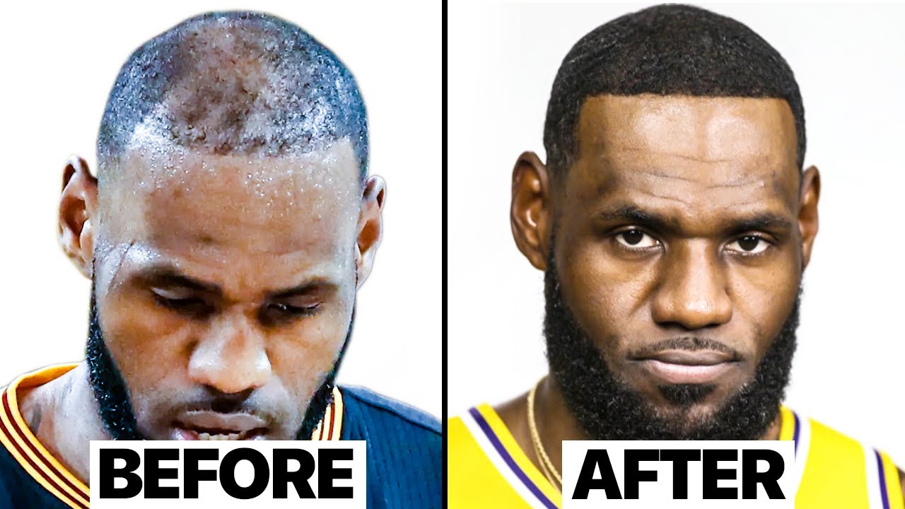 LeBron James Hair Transplant | Surgeon Reacts