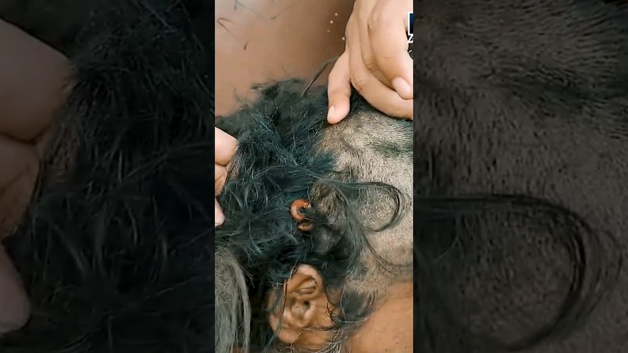 kok bisa dikepala pria ini bersarang kaki seribu ? #odgj #egoadriano