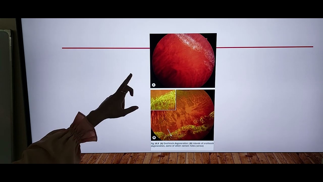 Retinal Detachment