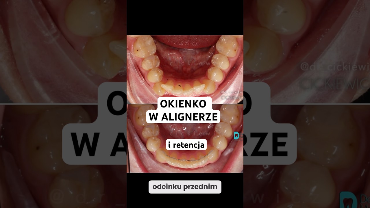 Dostosowanie ostatniej nakładki alignera do retencji - oszczędność czasu i koszt&oacute;w 💵👄 [PL]