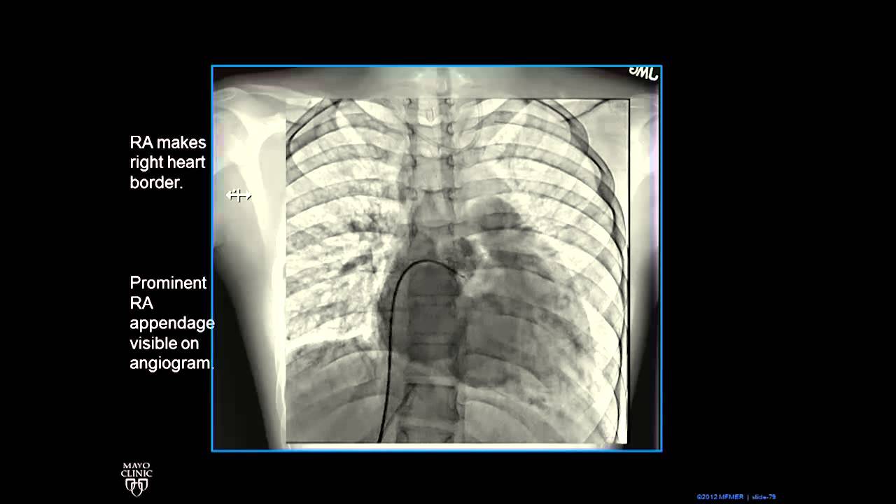 Plain Film Cardiac and Vascular Anatomy - Frontal Radiograph - Philip Araoz, M.D. - Part 4 of 10