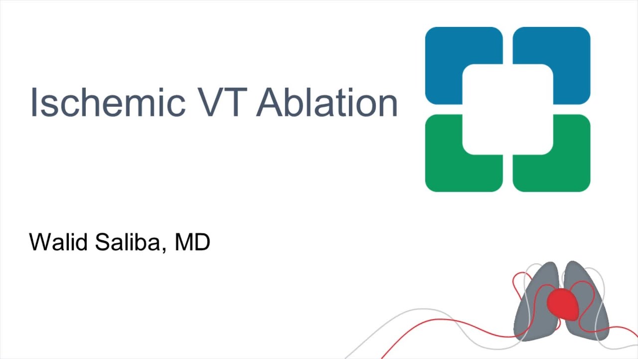Ischemic VT Ablation