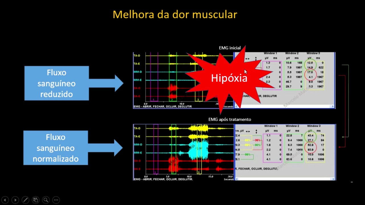 Toxina botulínica  na DTM - o que você precisa saber!