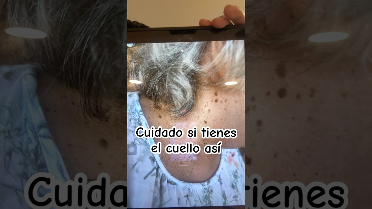 Si tienes el cuello as&iacute;, puedes tener esta enfermedad | Dr. William Guerrero. #medicina #shorts