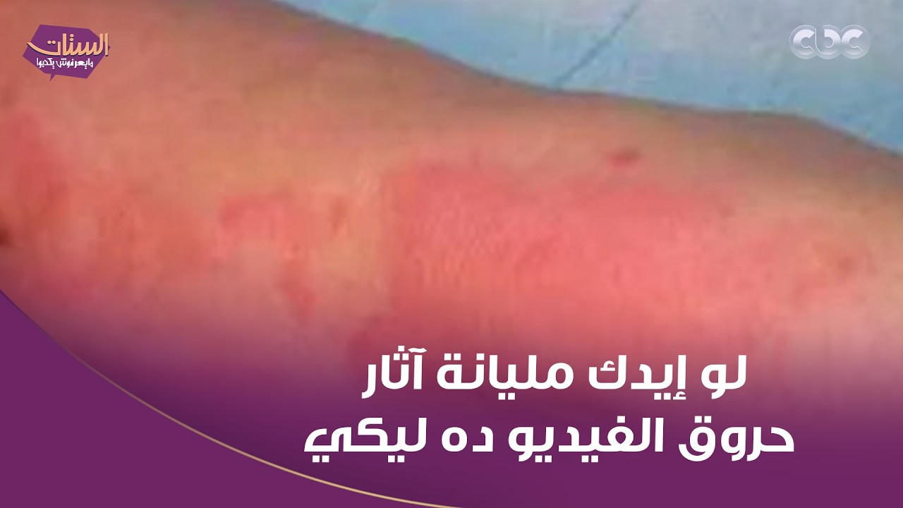 لو إيدك مليانة آثار حروق من الطبخ والبوتاجاز.. د. عاصم فرج حللنا أكبر مشكلة بتواجه الستات