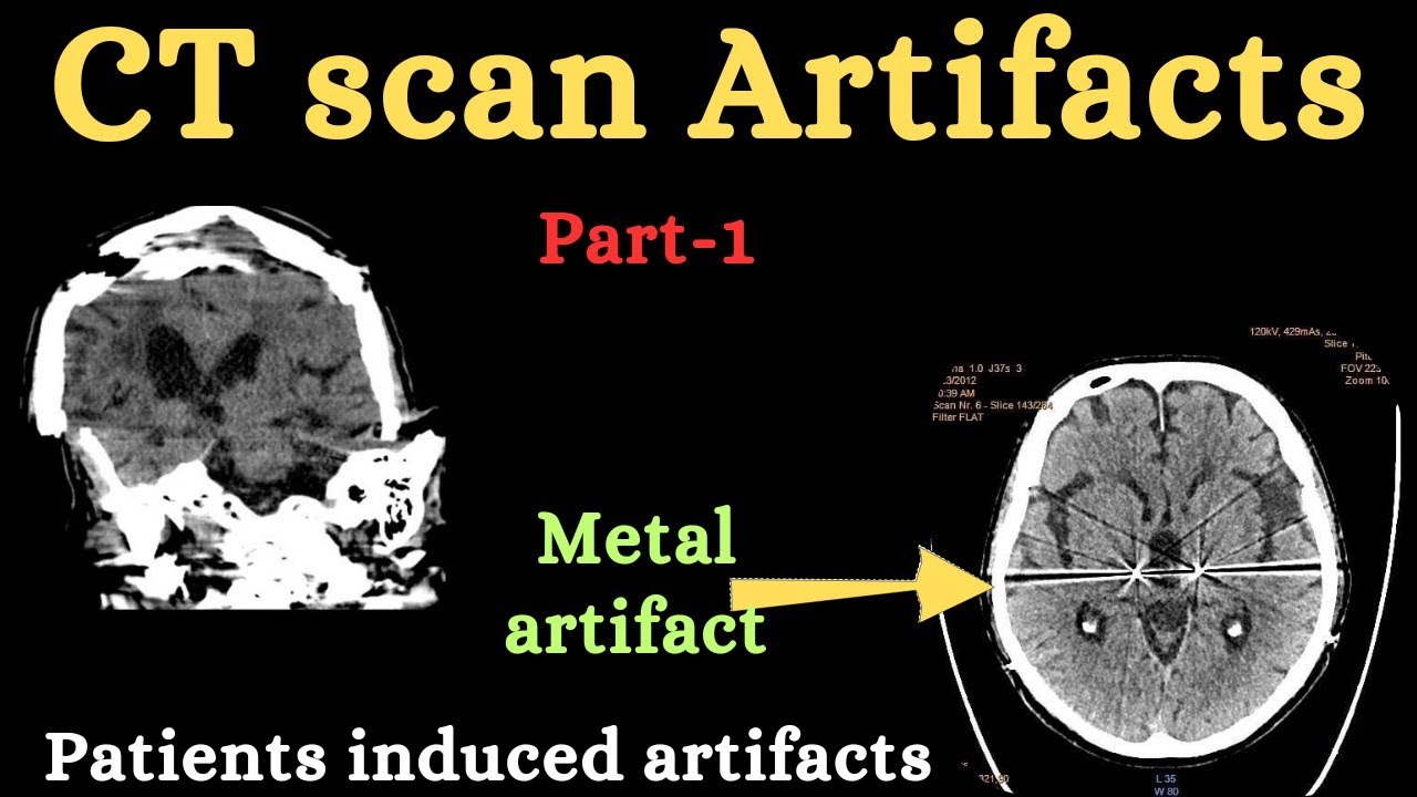 Part-1| CT scan artifacts |patient induced artifacts| CT artifacts in hindi