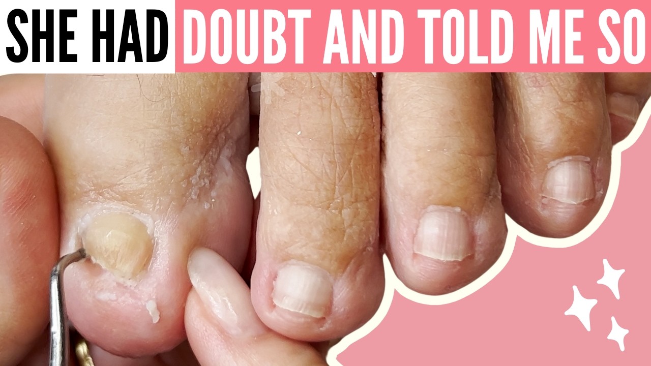 Toenail Pain Relief, Curling Toenails & Nail Trauma Recovery Pedicure