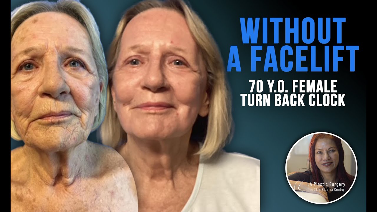 Non-Surgical Facelift Alternative: Plasma Skin Resurfacing on a 74-Year-Old  Dr. Lacerna