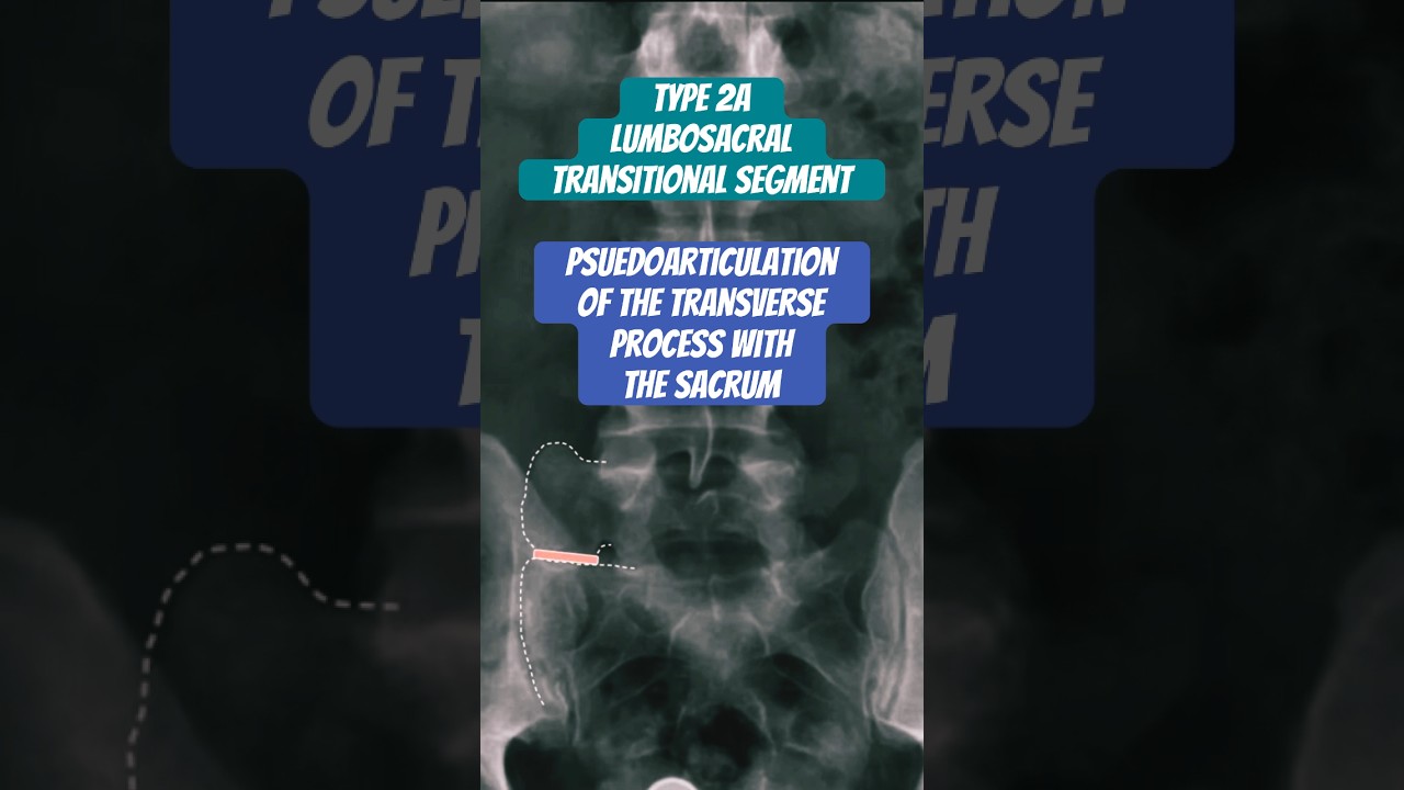 Lumbosacral Transitional Segment ⚕️ #radiology #spine #doctor