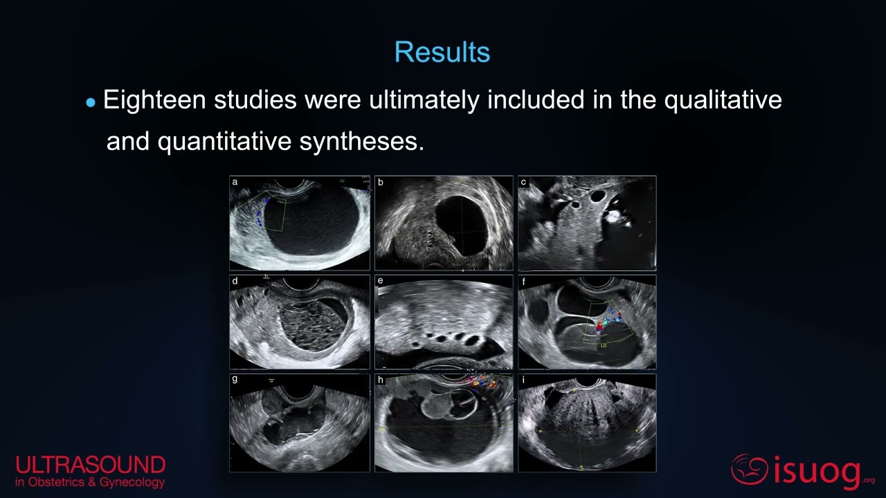 Video Abstract: the diagnostic accuracy of ultrasound signs for detecting adnexal torsion