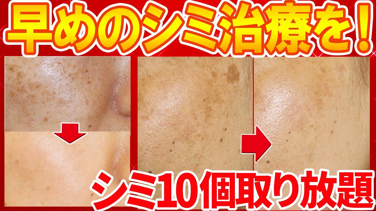 【シミは消えるのか】シミ取りレーザーを治療する前に見て欲しい【湘南美容クリニック医師が解説】