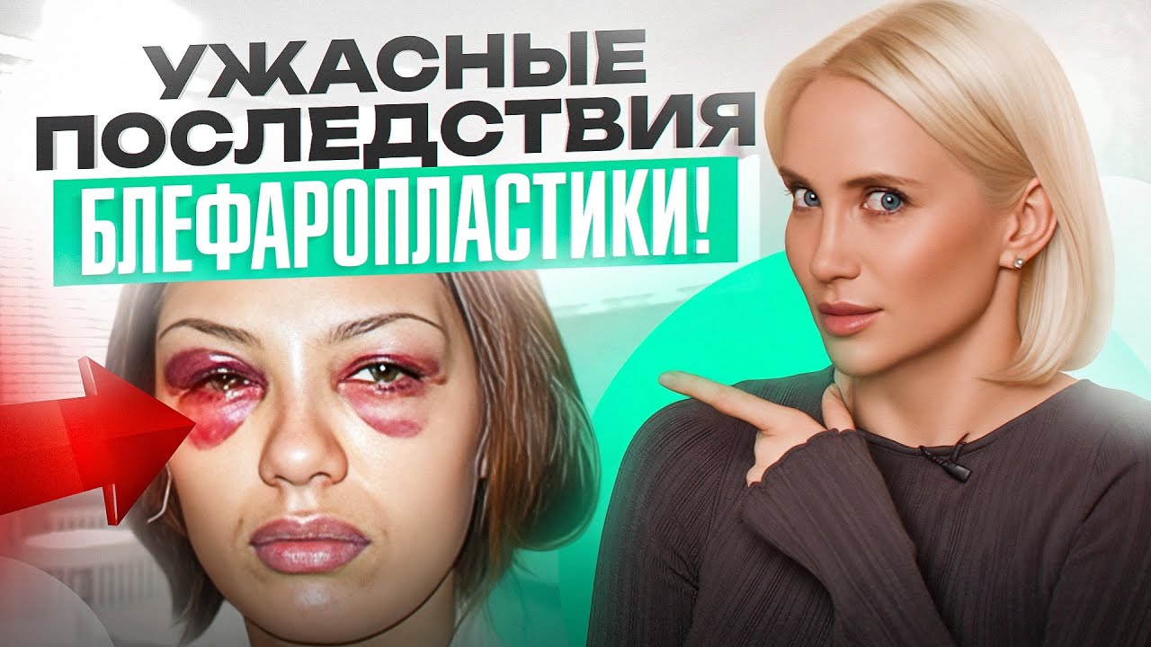 Блефаропластика от горе-хирургов, которая вас шокирует! ПОСЛЕДСТВИЯ