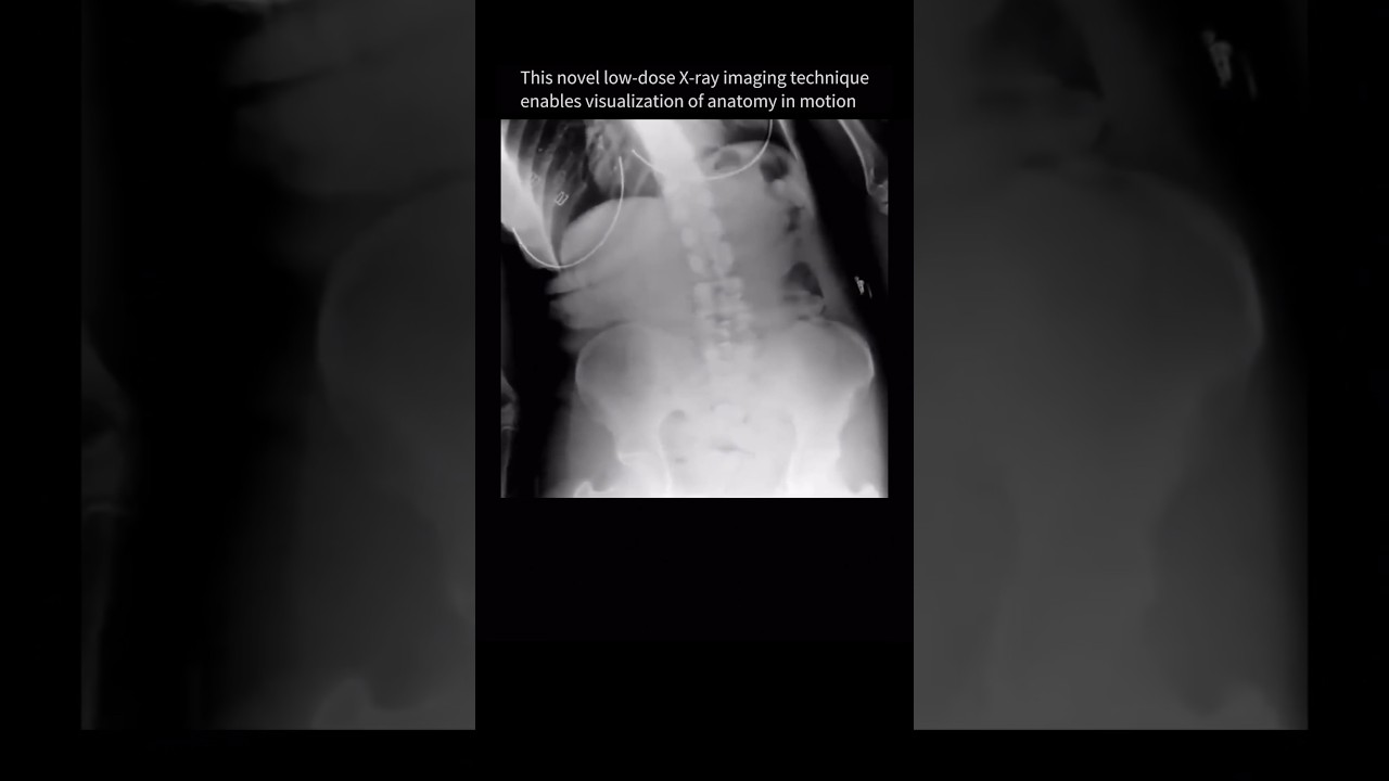 Spine movement seen for the FIRST-TIME with dynamic X-Ray #backpain #anatomy