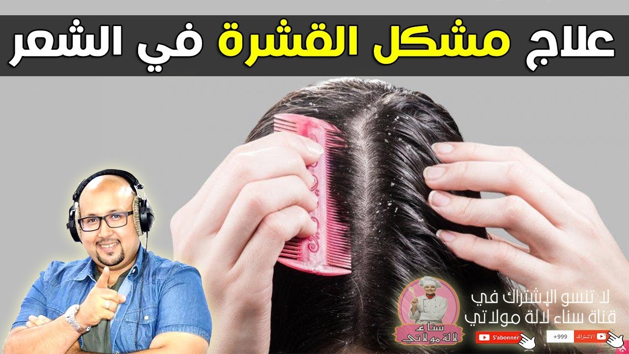 الوصفات والطرق الصحيحة لعلاج مشكل القشرة في الشعر من الدكتور عماد ميزاب imad mizab
