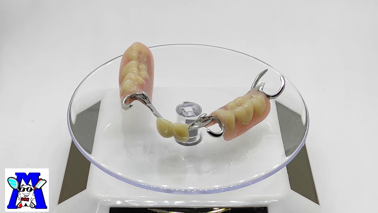 PRÓTESIS DENTAL ACRÍLICO METÁLICA REMOVIBLE .