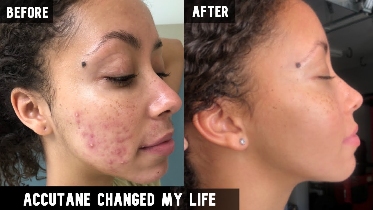 My Accutane Experience