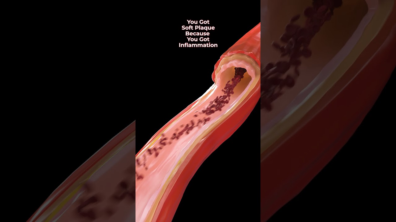 What Causes Soft Plaque? #heartattacksymptoms #heartdisease #autophagy