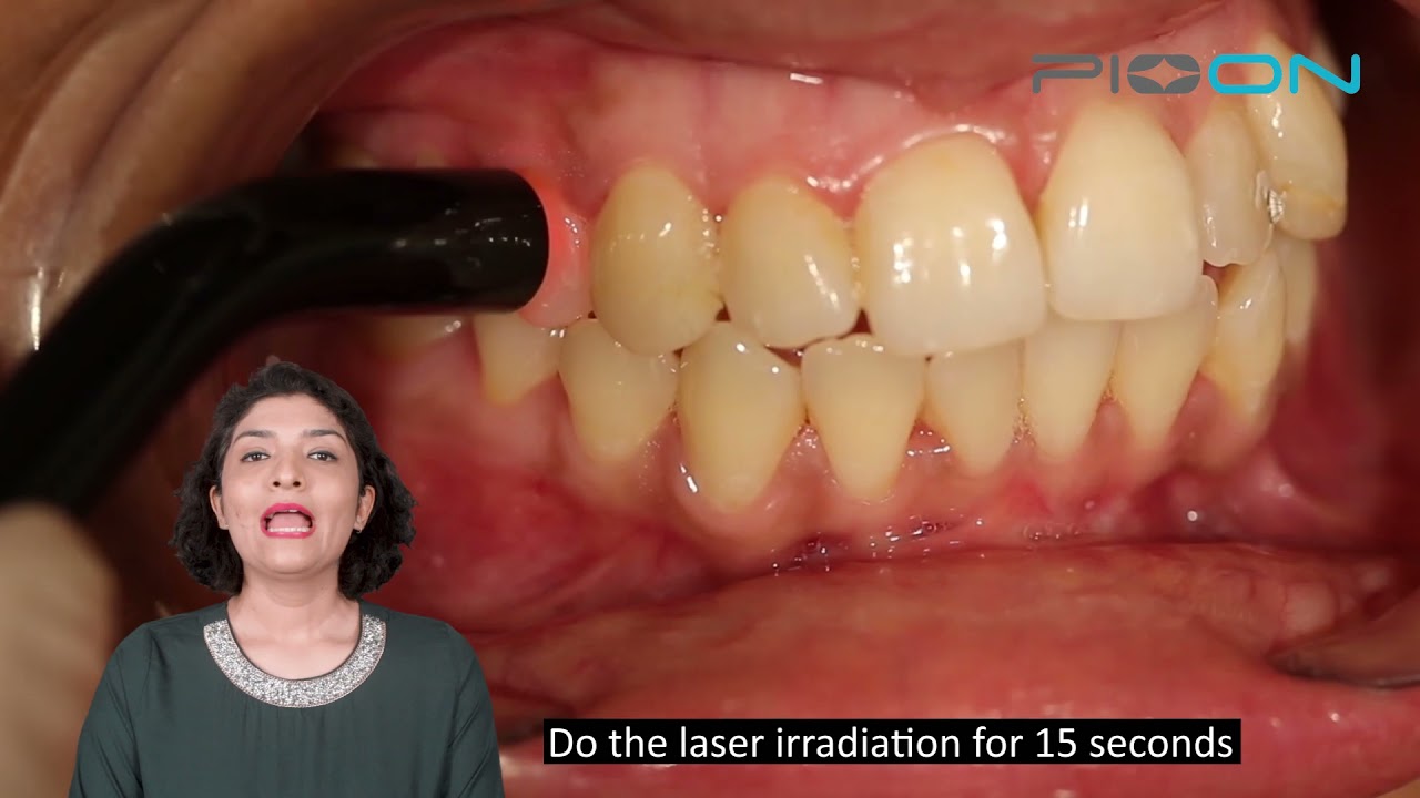 Management of Dentinal Hypersensitivity