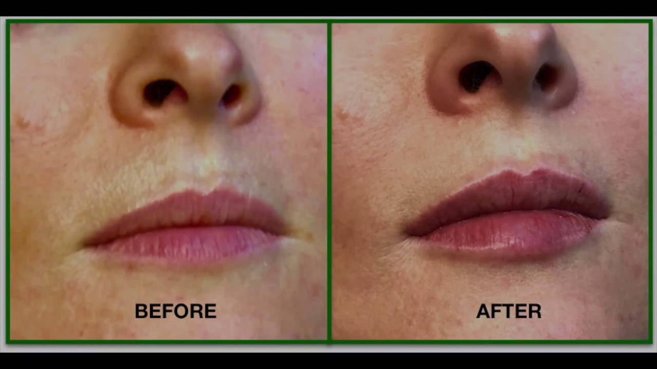 Medical Aesthetics By Dr Andr&eacute; | Lip Enhancement | Alderley Edge | Liverpool | Manchester