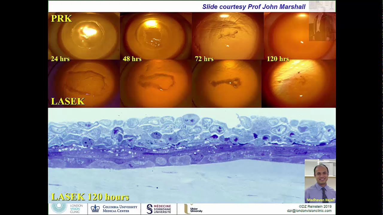 Photorefractive Keratectomy (PRK, LASEK, Epi-LASIK, ASA, TransPRK) - Surgeon Training Video