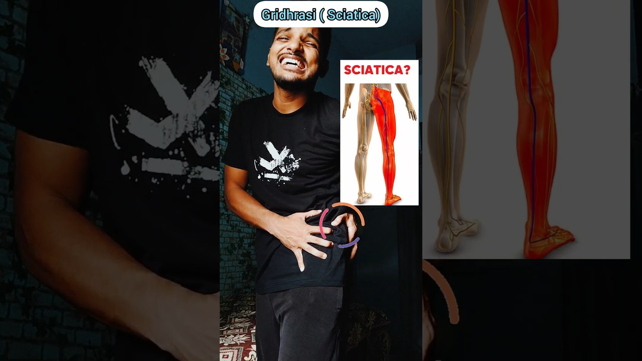 Gridhrasi (Sciatica ) fast pain relief || Kati Vasti 🤞#sciatica #sciaticapaintreatment #gridhrasi