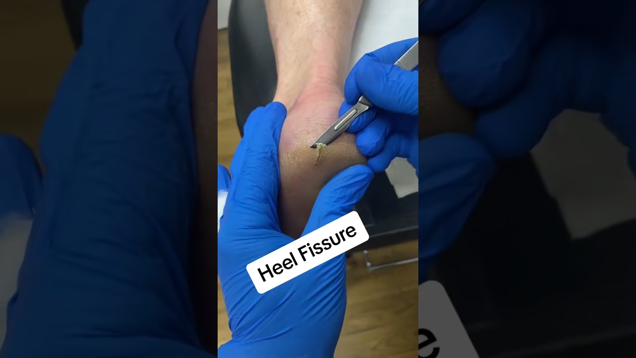 Watch and learn from our podiatrist as they demonstrate how a painful cracked heel fissure is remove