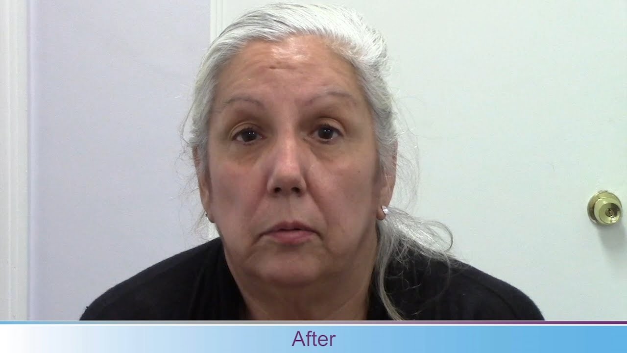 Before and After TD Treatment: 4-Point Improvement