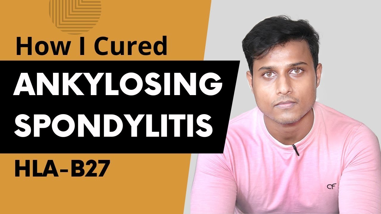 How I Cured My Ankylosing Spondylitis | Ayurvedic Treatment
