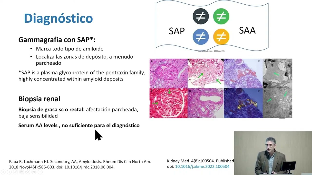 TRATAMIENTO ACTUAL Y FUTURO DE LAS AMILOIDOSIS NO AL.