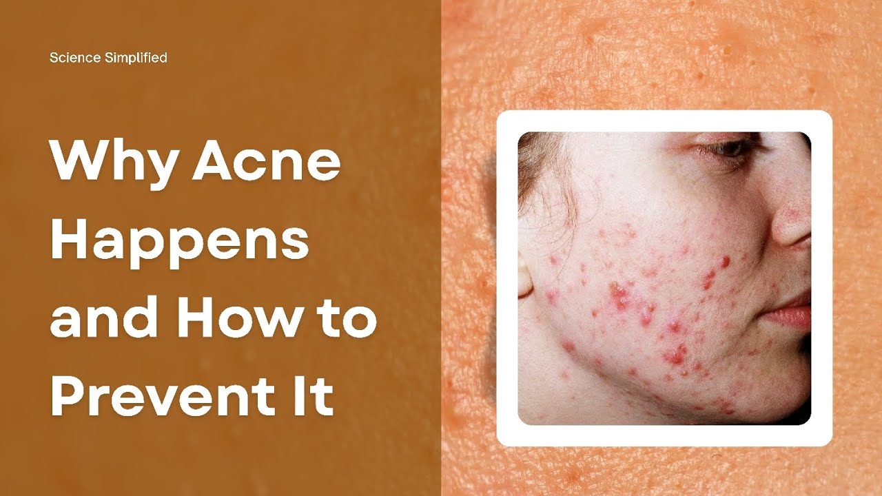 What Actually Causes Acne &mdash; and How To Treat It FAST | Science Simplified