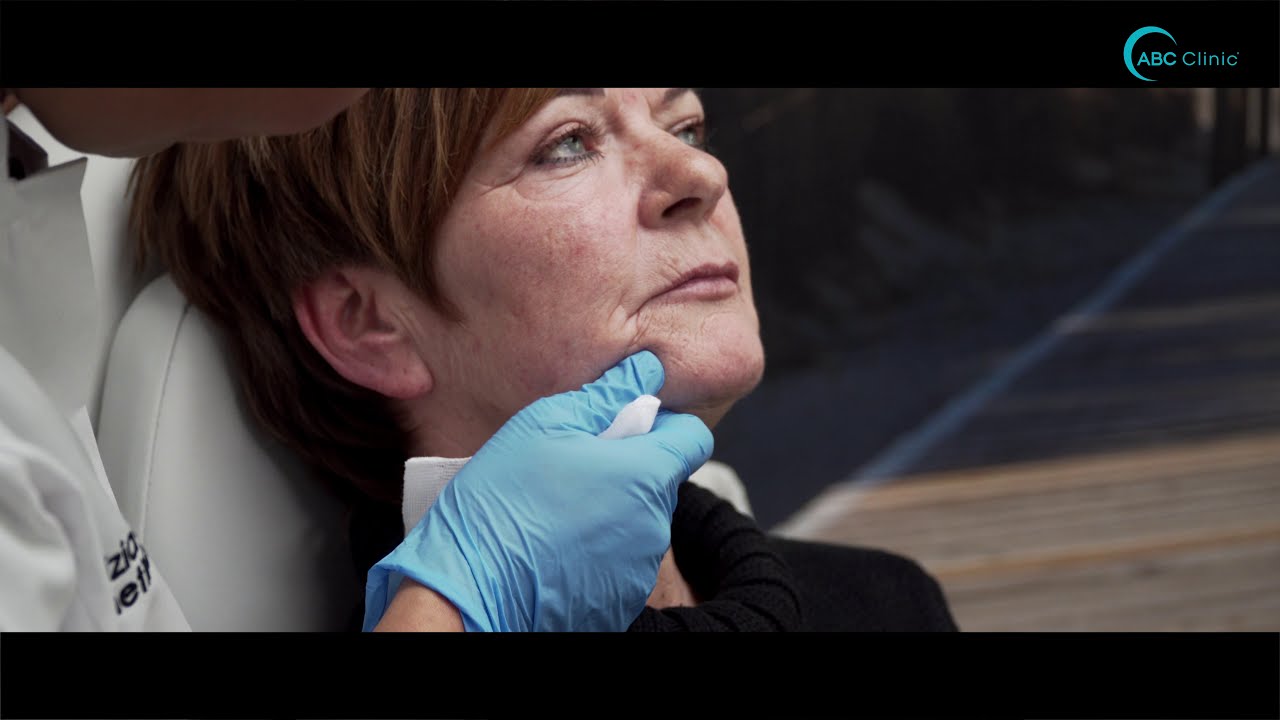Fillers mondhoeken hamsterwangen door Elizia Soares | ABC Clinic