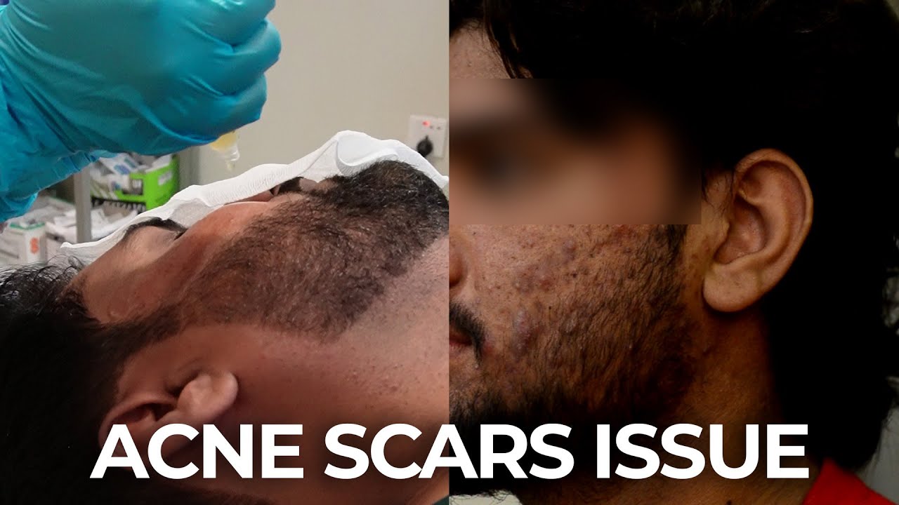 Erase Your Past | A New Hope for Stubborn Acne Scars & Pigmentation
