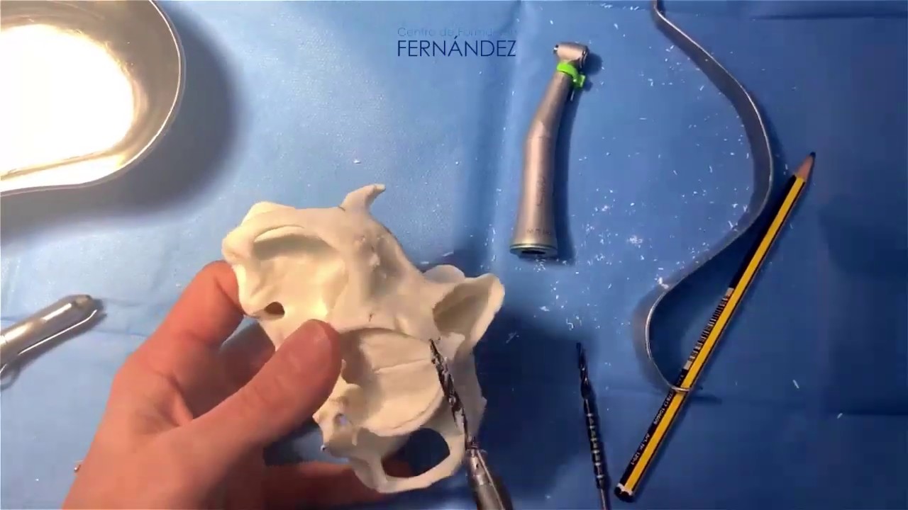 Implantes Cigomáticos