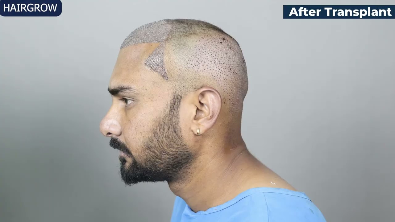 After Hair Transplant  Patient Honest Review Happy Patient #hairtransplant #hair 