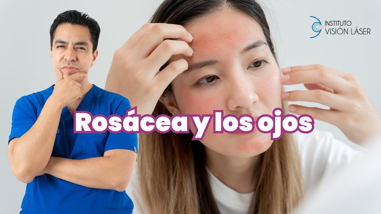 La rosácea y los ojos