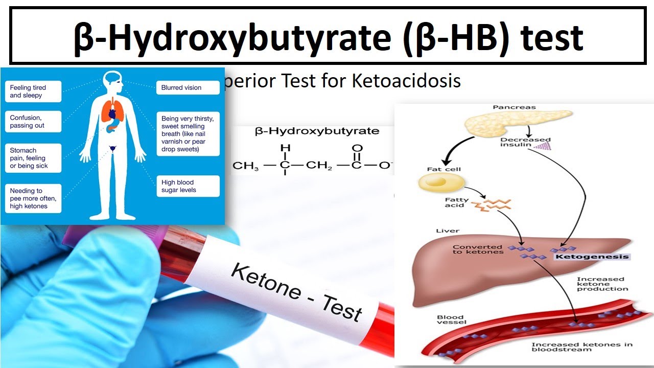 Beta -Hydroxybutyrate test.Ketone body assay.#Medilabacademy#BetaHb#diabeticketoacidosis