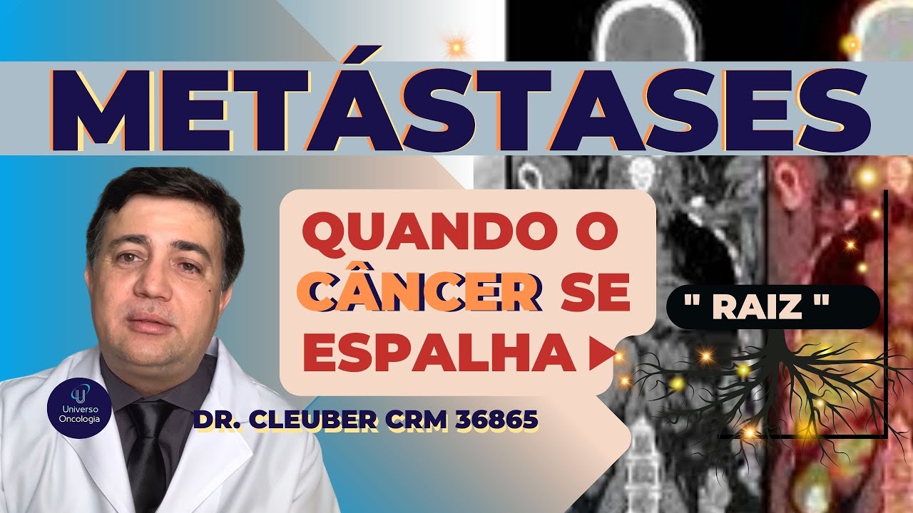 [ MET&Aacute;STASES:  &Eacute; Poss&iacute;vel a Cura Quando o C&acirc;ncer se Espalha?