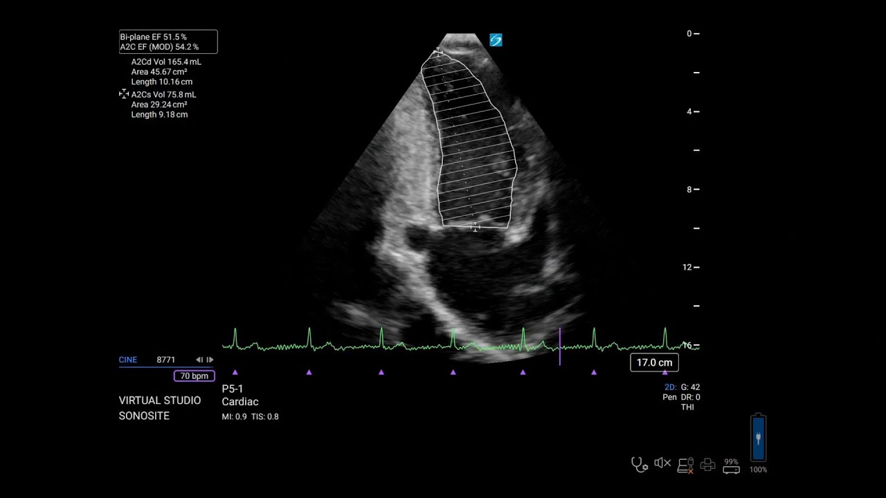 How-to Video: Ejection Fraction Calculation using Modified Simpson's for Sonosite LX and Sonosite PX