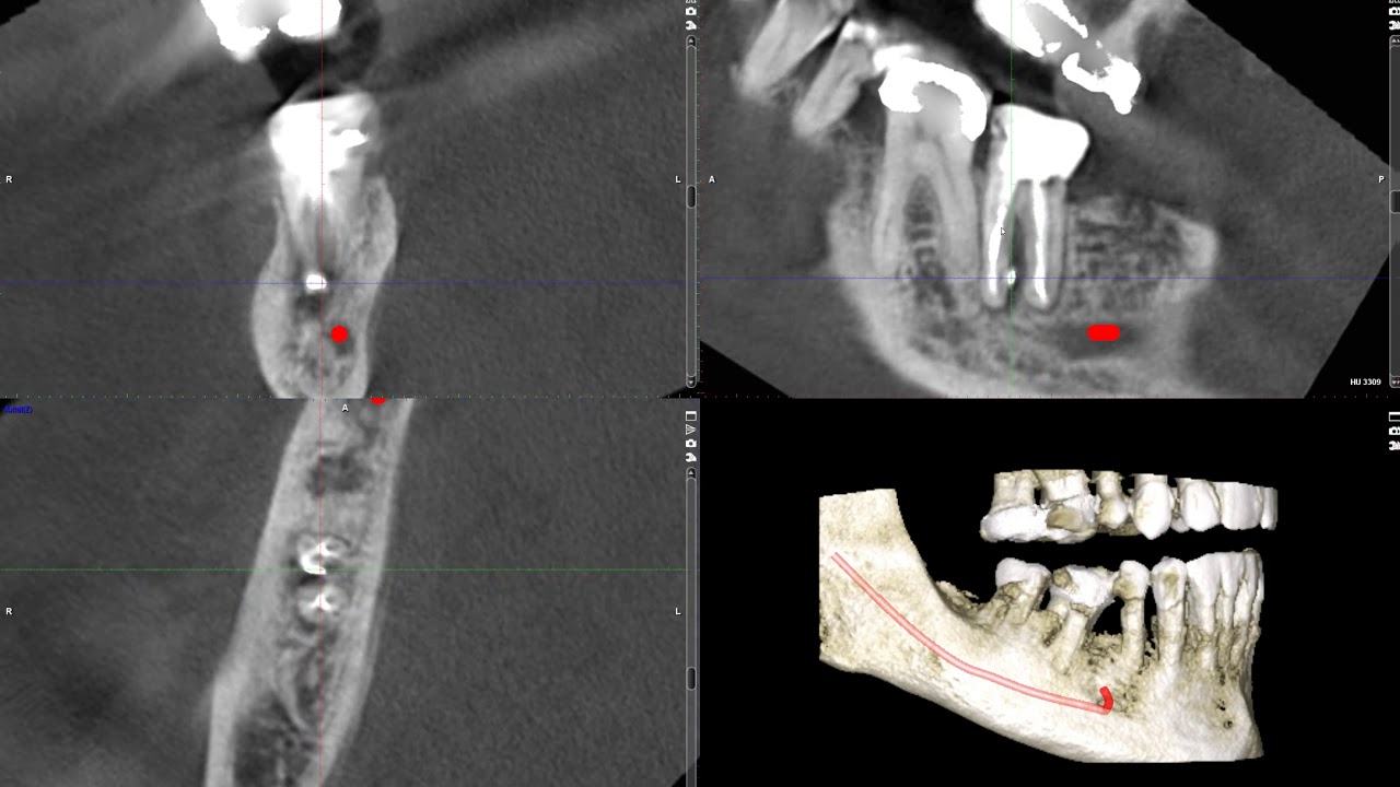 Root perforation or fracture on CBCT