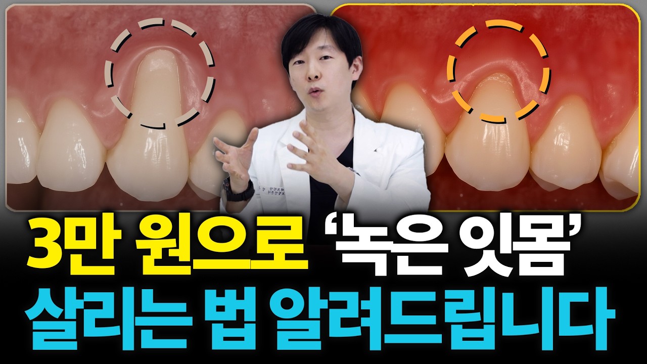 3만원으로 임플란트 안 해도 된다? 내려간 잇몸뼈 재생시켜주는 '엠도게인' 소개드립니다