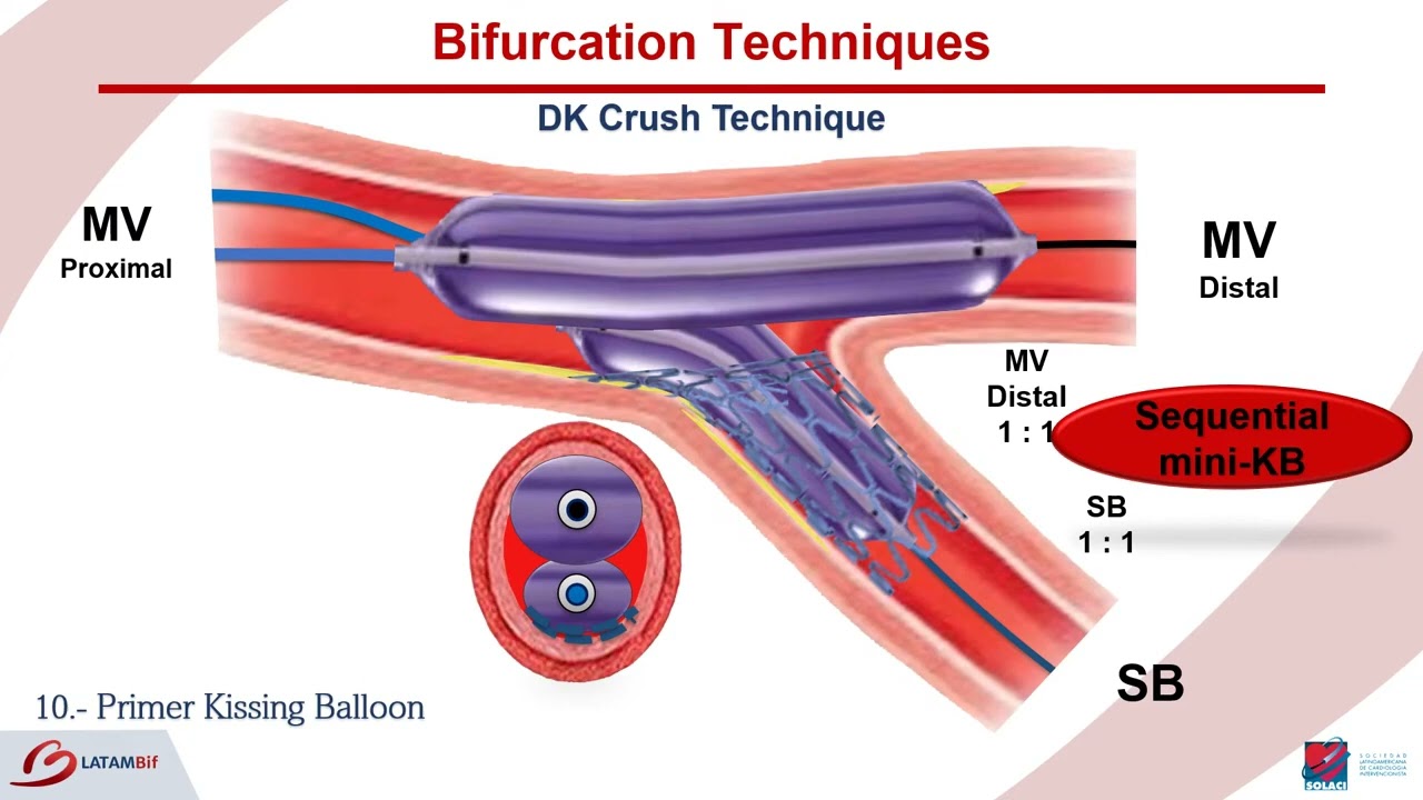 Bifurcations   DK Crush Technique  Step by step