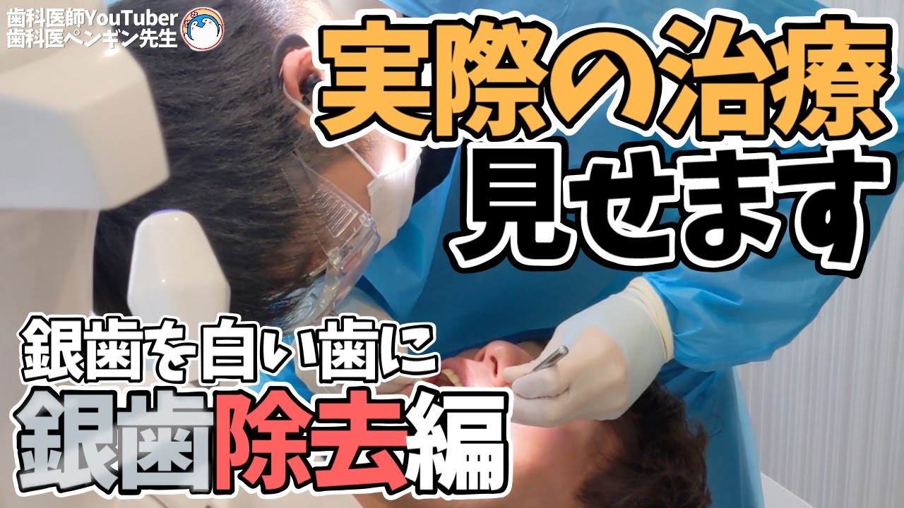 【歯を削る】銀歯を外して型取りをします【治療風景 セラミック治療 歯医者】dental dentist