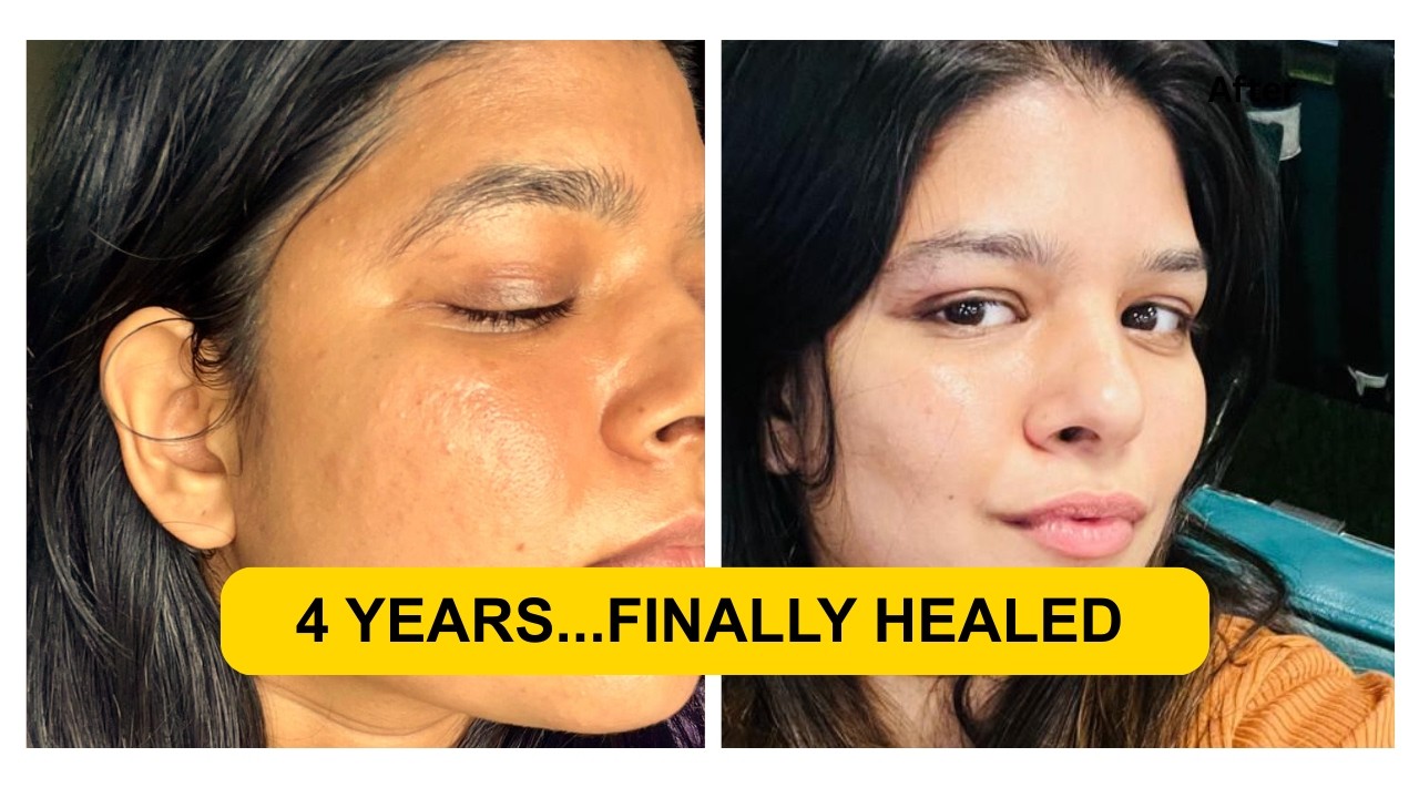 My Exact Skin Barrier Repair Routine That FINALLY Worked